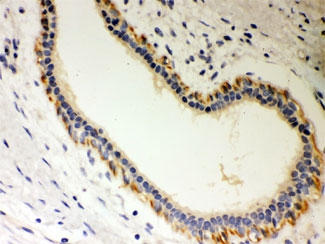 IHC testing of FFPE human breast cancer with STRAP antibody. HIER: Boil the pa