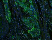 Immunofluorescent staining of FFPE human esophageal squamous cancer with HLA-C antibody (green) at 1ug/ml and DAPI nuclear stain. HIER: boil tissue sections in pH6, 10mM citrate buffer, for 10-20 min and allow to cool before testing.