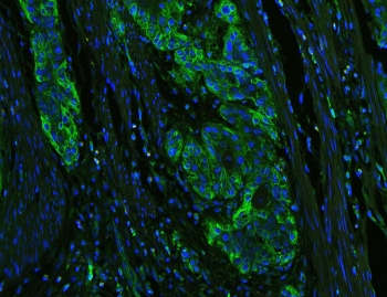 Immunofluorescent staining of FFPE human esophageal squamous cancer with HLA-C antibody (green) at 1ug/ml and DAPI nuclear stain. HIER: boil tissue sections in pH6, 10mM citrate buffer, for 10-20 min and allow to cool before testing.