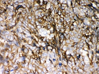 IHC testing of FFPE human lung cancer with HLA-C antibody. HIER: Boil the paraffin sections in pH 6, 10mM citrate buffer for 20 minutes and allow to cool prior to staining.