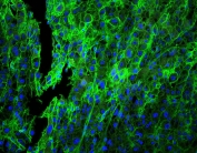 Immunofluorescent staining of FFPE human lung cancer with HLA-C antibody (green) at 1ug/ml and DAPI nuclear stain. HIER: boil tissue sections in pH6, 10mM citrate buffer, for 10-20 min and allow to cool before testing.