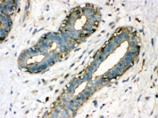IHC-P: TGM2 antibody testing of human breast cancer