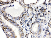 IHC testing of FFPE human thyroid cancer tissue with CGRP antibody. HIER: Boil the paraffin sections in pH 6, 10mM citrate buffer for 20 minutes and allow to cool prior to testing.