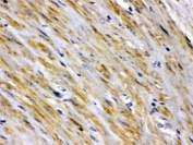 IHC testing of FFPE human intestinal cancer tissue with FABP2 antibody. HIER: Boil the paraffin sections in pH 6, 10mM citrate buffer for 20 minutes and allow to cool prior to testing.