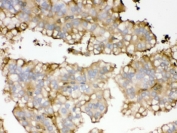 IHC testing of FFPE human kidney cancer tissue with APOA1 antibody. HIER: Boil the paraffin sections in pH 6, 10mM citrate buffer for 20 minutes and allow to cool prior to testing.