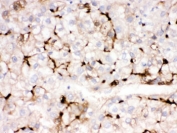 IHC testing of FFPE human liver cancer tissue with APOA1 antibody. HIER: Boil the paraffin sections in pH 6, 10mM citrate buffer for 20 minutes and allow to cool prior to testing.