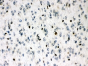 IHC testing of FFPE human glioma tissue with MEF2A antibody. HIER: Boil the paraffin sections in pH 6, 10mM citrate buffer for 20 minutes and allow to cool prior to testing.