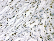 IHC testing of FFPE human meningeoma tissue with MEF2A antibody. HIER: Boil the paraffin sections in pH 6, 10mM citrate buffer for 20 minutes and allow to cool prior to testing.
