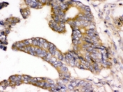 IHC testing of FFPE human intestinal cancer tissue with WNK1 antibody. HIER: Boil the paraffin sections in pH 6, 10mM citrate buffer for 20 minutes and allow to cool prior to testing.