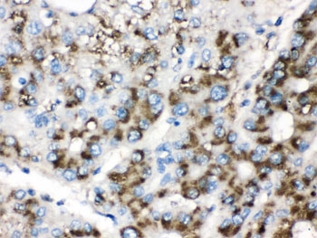 IHC testing of FFPE human liver cancer tissue with Catalase antibody. HIER: Boil the paraffin sections in pH 6, 10mM citrate buffer for 20 minutes and allow to cool prior to testing.
