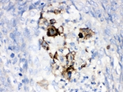 IHC testing of FFPE human lung cancer tissue with Complement Factor B antibody. HIER: Boil the paraffin sections in pH 6, 10mM citrate buffer for 20 minutes and allow to cool prior to testing.
