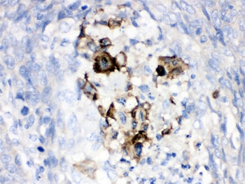 IHC testing of FFPE human lung cancer tissue with Complement Factor B antibody. HIER: Boil the pa