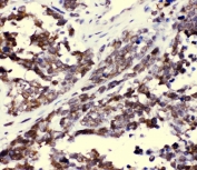 IHC staining of FFPE human lung cancer with CCT3 antibody at 1ug/ml. HIER: boil tissue sections in pH6, 10mM citrate buffer, for 10-20 min and allow to cool before testing.
