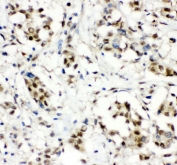 IHC staining of FFPE human breast cancer with CCT3 antibody. HIER: boil tissue sections in pH6, 10mM citrate buffer, for 10-20 min and allow to cool before testing.