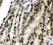 IHC staining of FFPE human intestinal cancer with CCT3 antibody. HIER: boil tissue sections in pH6, 10mM citrate buffer, for 10-20 min and allow to cool before testing.