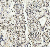 IHC staining of FFPE human thyroid tissue with YAP1 antibody. HIER: boil tissue sections in pH8 EDTA for 20 min and allow to cool before testing.