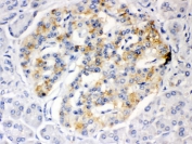 IHC testing of FFPE human pancreatic cancer tissue with ISG15 antibody. HIER: Boil the paraffin sections in pH 6, 10mM citrate buffer for 20 minutes and allow to cool prior to testing.