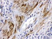IHC testing of FFPE human prostate cancer tissue with Cofilin 2 antibody. HIER: Boil the paraffin sections in pH 6, 10mM citrate buffer for 20 minutes and allow to cool prior to testing.