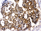 IHC testing of FFPE human intestinal cancer tissue with TCP1 epsilon antibody. HIER: Boil the paraffin sections in pH 6, 10mM citrate buffer for 20 minutes and allow to cool prior to testing.