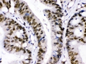 IHC testing of FFPE human intestinal cancer tissue with CRM1 antibody. Boil the paraffin sections in pH 6, 10mM citrate buffer for 20 minutes and allow to cool prior to testing.