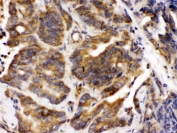 IHC testing of FFPE human intestinal cancer tissue with Talin 2 antibody. HIER: Boil the paraffin sections in pH 6, 10mM citrate buffer for 20 minutes and allow to cool prior to testing.