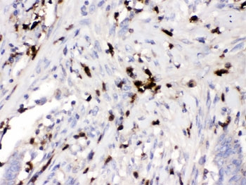 IHC testing of FFPE human intestinal cancer tissue with ORM1 antibody. HIER: Boil
