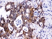IHC testing of FFPE human intestinal cancer tissue with SIP antibody. HIER: Boil the paraffin sections in pH 6, 10mM citrate buffer for 20 minutes and allow to cool prior to testing.