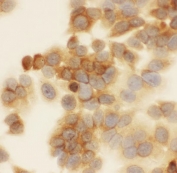 Immunocytochemical staining of FFPE human MCF-7 with SIP antibody. HIER: boil tissue sections in pH6, 10mM citrate buffer, for 20 min and allow to cool before testing.