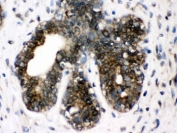 IHC testing of FFPE human breast cancer tissue with TCP1 delta antibody. HIER: Boil the paraffin sections in pH 6, 10mM citrate buffer for 20 minutes and allow to cool prior to testing.
