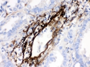 IHC testing of FFPE human lung cancer tissue with MGP antibody. HIER: Boil the paraffin sections in pH 6, 10mM citrate buffer for 20 minutes and allow to cool prior to testing.