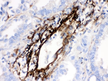 IHC testing of FFPE human lung cancer tissue with MGP antibody. HIER: Boil the paraffin sections in pH 6, 10mM citrate buffer for 20 minutes an