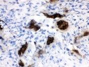 IHC testing of FFPE human osteosarcoma tissue with Osteocalcin antibody. HIER: Boil the paraffin sections in pH 6, 10mM citrate buffer for 20 minutes and allow to cool prior to testing.