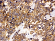 IHC testing of FFPE human lung cancer tissue with DDAH2 antibody at 1ug/ml. HIER: steam in pH6 citrate buffer and allow to cool prior to staining.