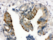 IHC testing of FFPE human intestinal cancer tissue with HMGB2 antibody at 1ug/ml. HIER: steam in pH6 citrate buffer and allow to cool prior to staining.