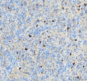 IHC staining of FFPE human glioma tissue with Alpha Internexin antibody. HIER: boil tissue sections in pH8 EDTA for 20 min and allow to cool before testing.
