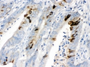 IHC testing of FFPE human intestinal cancer tissue with ITLN1 antibody at 1ug/ml. HIER: steam in pH6 citrate buffer and allow to cool prior to staining.