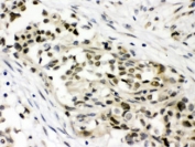 IHC testing of FFPE human breast cancer tissue with MAP3K8 antibody at 1ug/ml. HIER: steam in pH6 citrate buffer and allow to cool prior to staining.