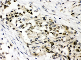 IHC testing of FFPE human breast cancer tissue with MAP3K8 antibody at