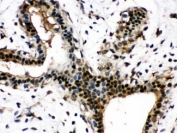 IHC testing of FFPE human breast cancer tissue with Visfatin antibody at 1ug/ml. HIER: steam in pH6 citrate buffer and allow to cool prior to staining.