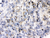 IHC testing of FFPE human lung cancer tissue with Perilipin 3 antibody at 1ug/ml. HIER: steam in pH6 citrate buffer and allow to cool prior to staining.