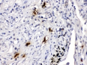 IHC testing of FFPE human lung cancer tissue with Mast Cell Tryptase antibody at 1ug/ml. HIER: steam in pH6 citrate buffer and allow to cool prior to staining.