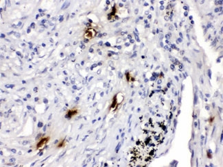 IHC testing of FFPE human lung cancer tissue with Mast Cell Tryptase antibody at 1ug/ml. HIER: steam in pH6 citrate