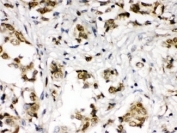 IHC testing of FFPE human breast cancer tissue with ABR antibody at 1ug/ml. HIER: steam in pH6 citrate buffer and allow to cool prior to staining.