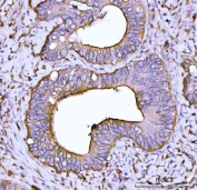 IHC staining of FFPE human colonic adenocarcinoma tissue with ACTN4 antibody. HIER: boil tissue sections in pH8 EDTA for 20 min and allow to cool before testing.