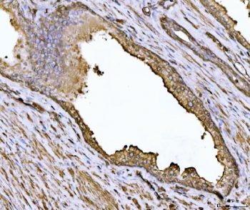 IHC staining of FFPE human prostate cancer tissue with ACTN4 antibody. HIER: boil tissue sections in pH8 EDTA for 20 min and allow to cool before testing.