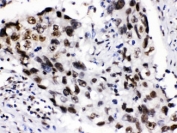 IHC testing of FFPE human lung cancer tissue with ADAR1 antibody at 1ug/ml. HIER: steam in pH6 citrate buffer and allow to cool prior to staining.