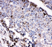 IHC staining of FFPE human lung cancer with AEBP2 antibody. HIER: boil tissue sections in pH6, 10mM citrate buffer, for 20 min and allow to cool before testing.