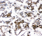 IHC staining of FFPE human breast cancer with AEBP2 antibody. HIER: boil tissue sections in pH6, 10mM citrate buffer, for 20 min and allow to cool before testing.