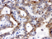 IHC testing of FFPE human liver cancer tissue with ALDH3A2 antibody at 1ug/ml. HIER: steam in pH6 citrate buffer and allow to cool prior to staining.