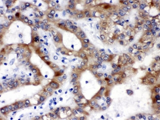 IHC testing of FFPE human liver cancer tissue with ALDH3A2 antibody at 1ug/ml. HIER: steam in pH6 citrate buffer